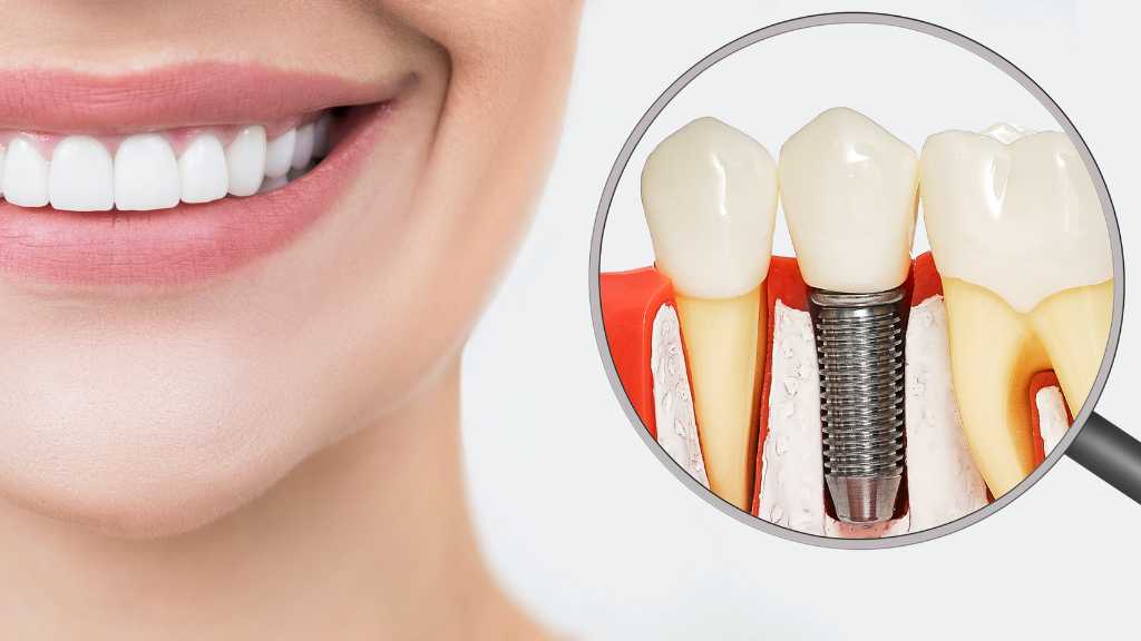 dental implants jaw youfirst dental airdrie