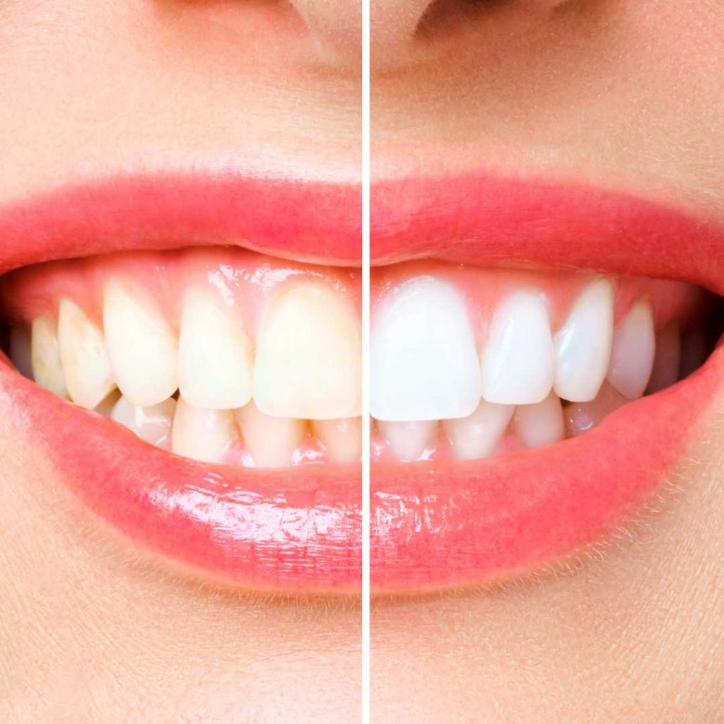 airdrie tooth whitening