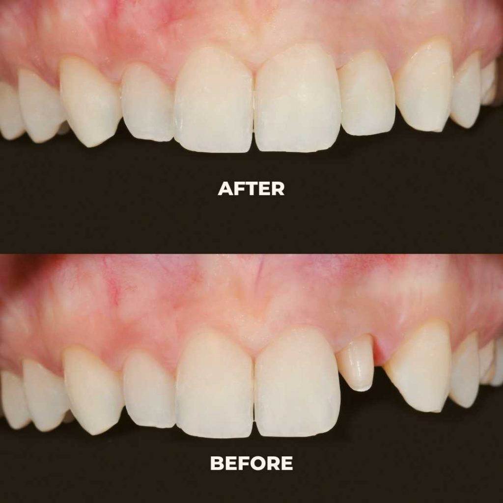 dental crowns airdrie