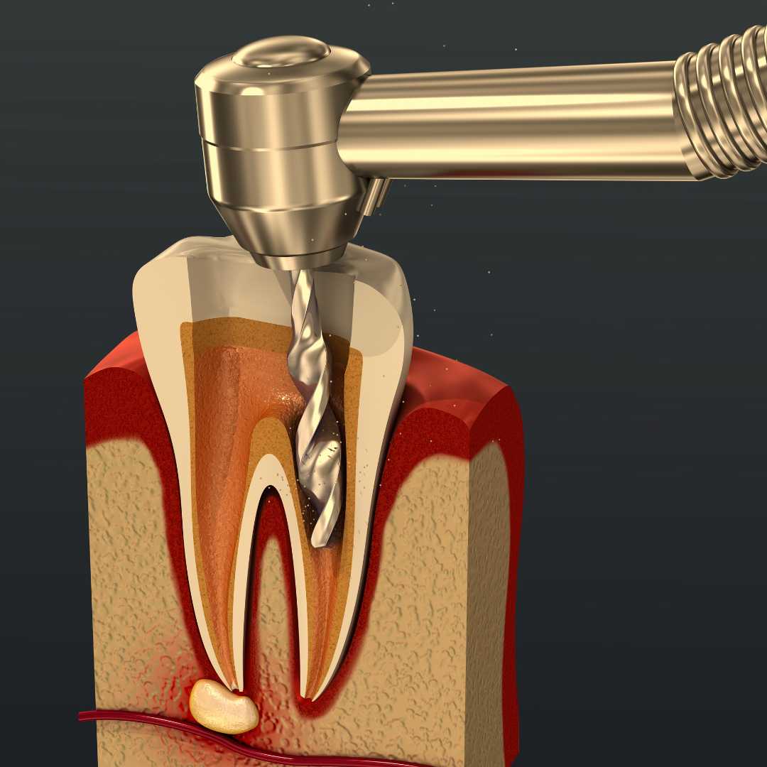 Root Canal Treatment Airdrie | You First Dental | #1 Dentist