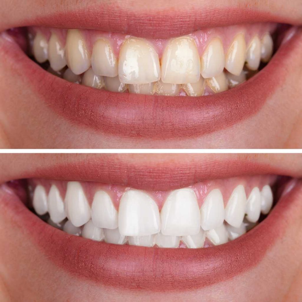 teeth whitening airdrie