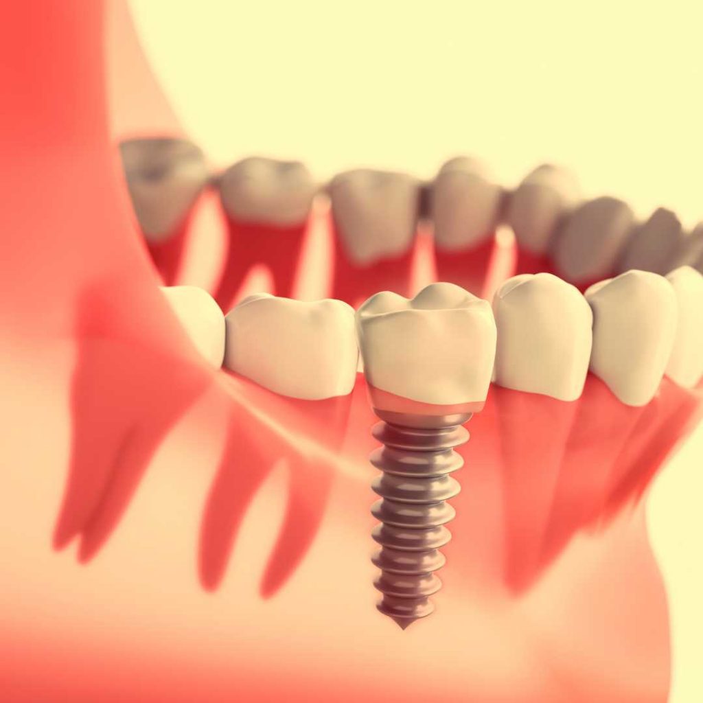 Dental Implants Airdrie