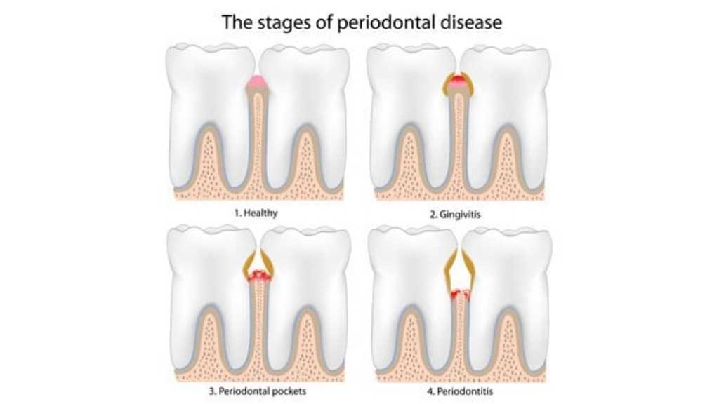 periodontal-disease-airdrie