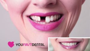 implants-dentist-in airdrie